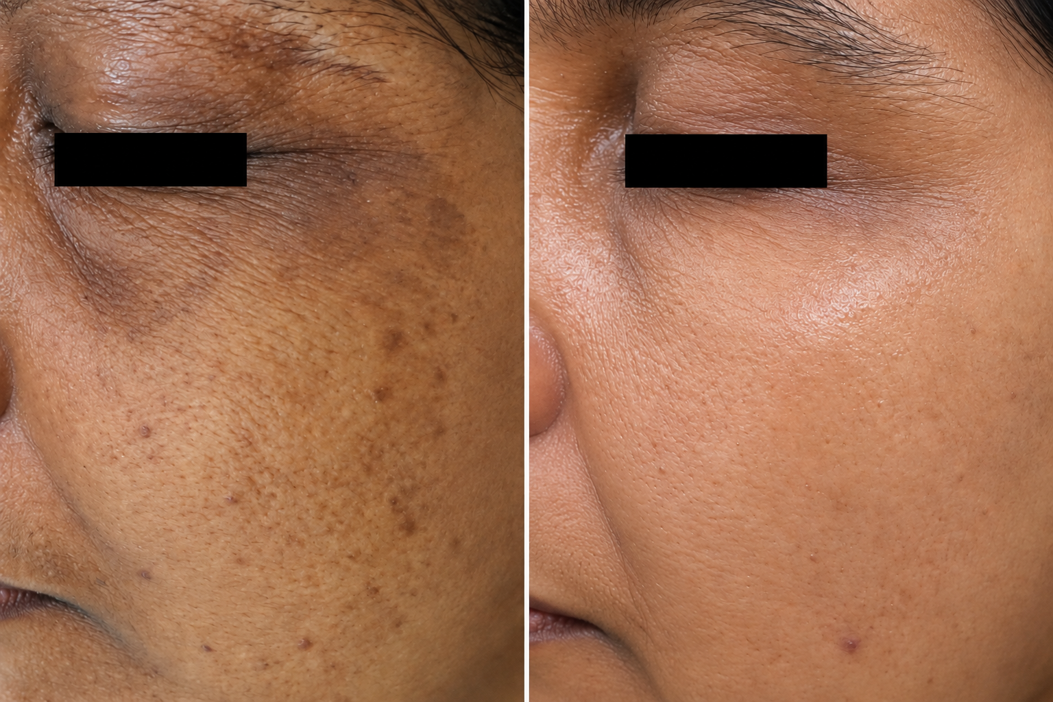 Before and after clinical clearance of skin lesions and papules