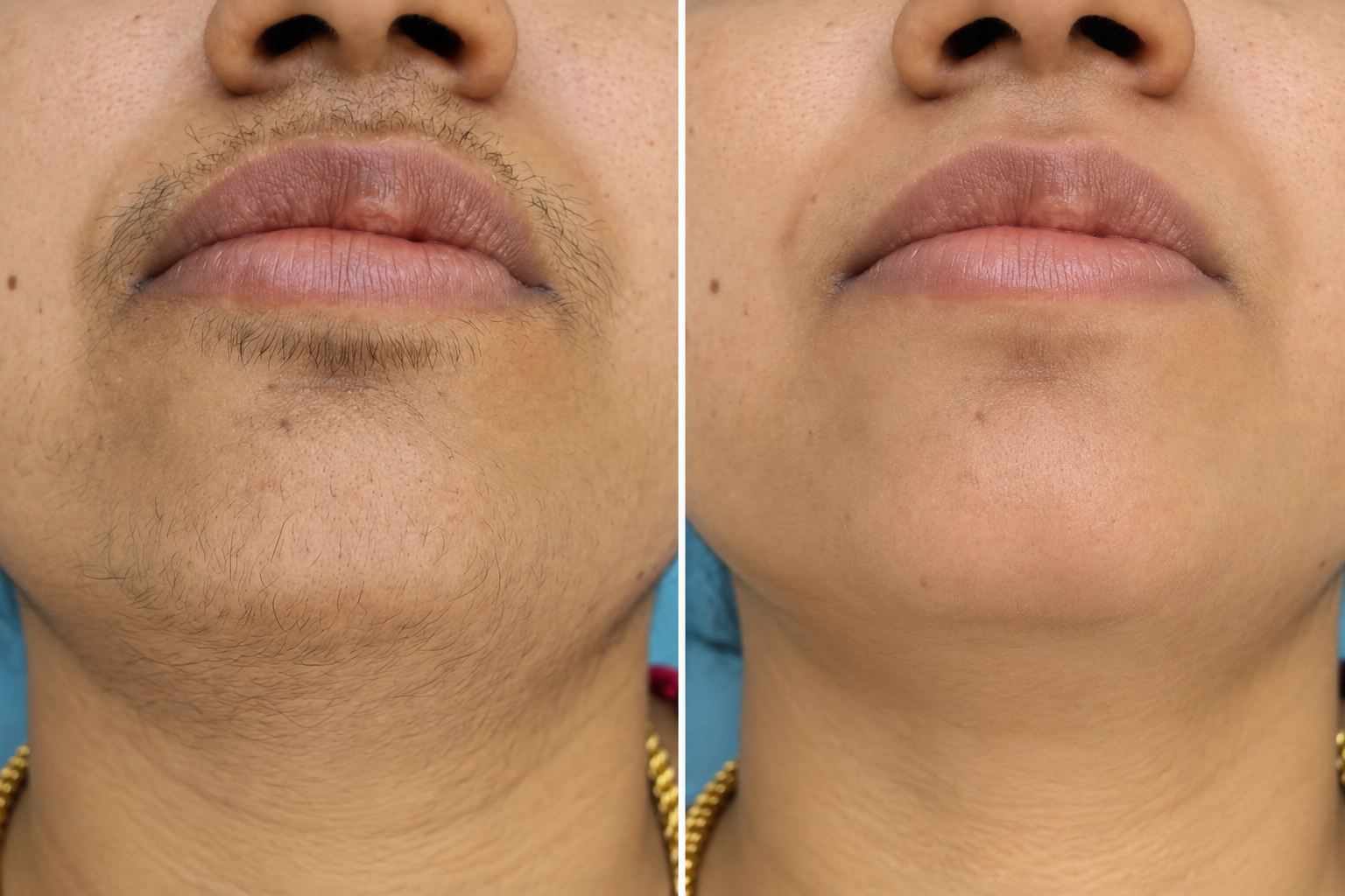 Before and after clinical clearance of facial DPN and skin tags