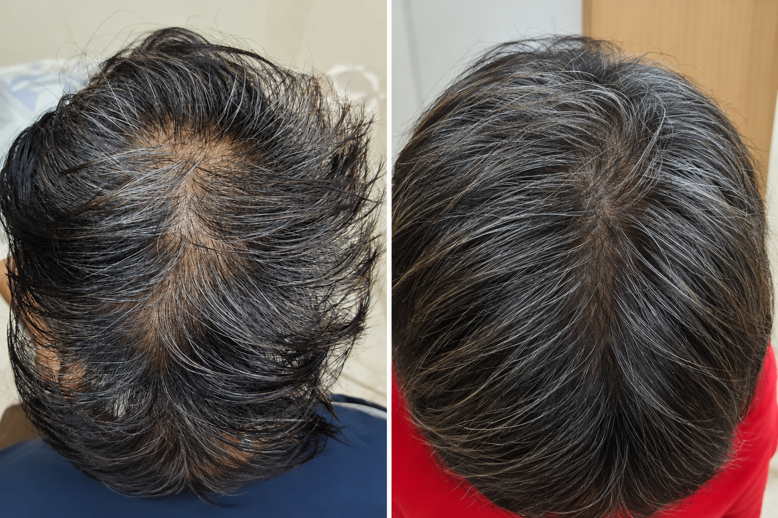 Before and after crown scalp hair thinning and density restoration