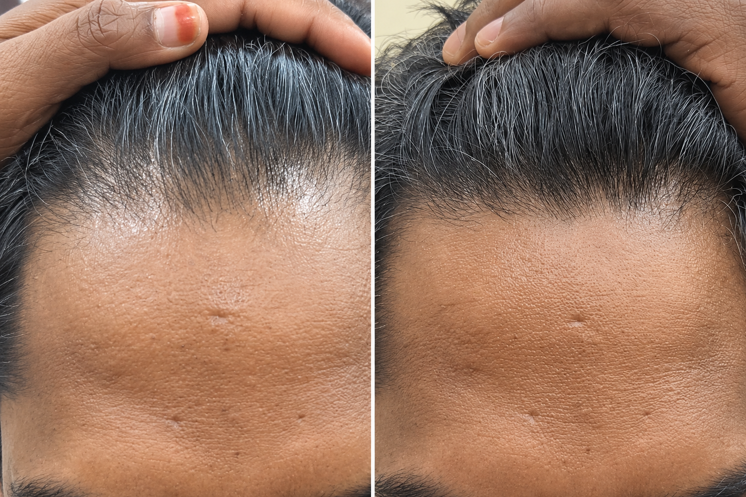 Before and after clinical results for frontal hairline regrowth and restoration